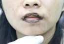 16% biến chứng thẩm mỹ liên quan thiết bị năng lượng