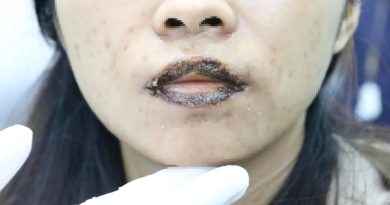 16% biến chứng thẩm mỹ liên quan thiết bị năng lượng