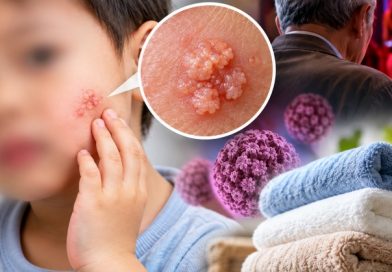 Bé 3 tuổi xuất hiện tổn thương giống mào gà trên mặt, bác sĩ cảnh báo nguồn lây bất ngờ: Lỗi của ông nội