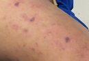 TP.HCM thông tin về học sinh mắc bệnh do não mô cầu, 99 người tiếp xúc