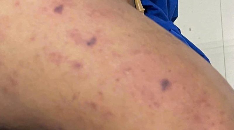 TP.HCM thông tin về học sinh mắc bệnh do não mô cầu, 99 người tiếp xúc